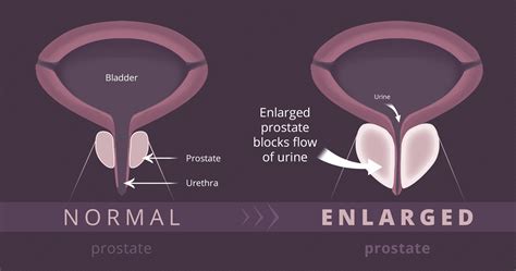 Prostate